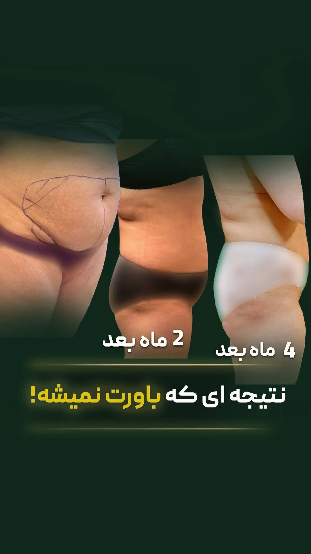 فیلر ساق پا | فیلربادی | دکتر سعیده فتح‌زاده